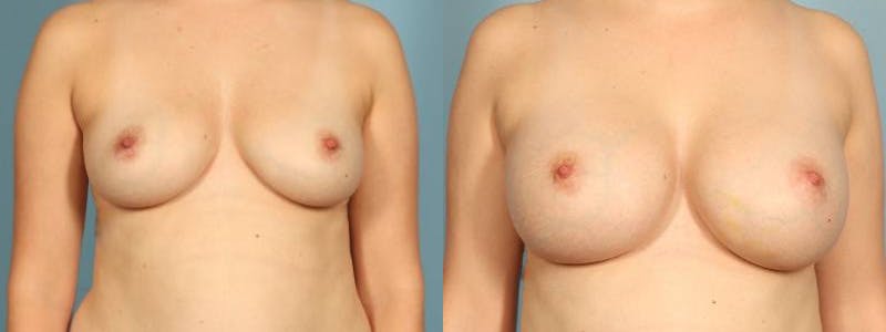 Breast Augmentation Before & After Gallery - Patient 361255 - Image 1