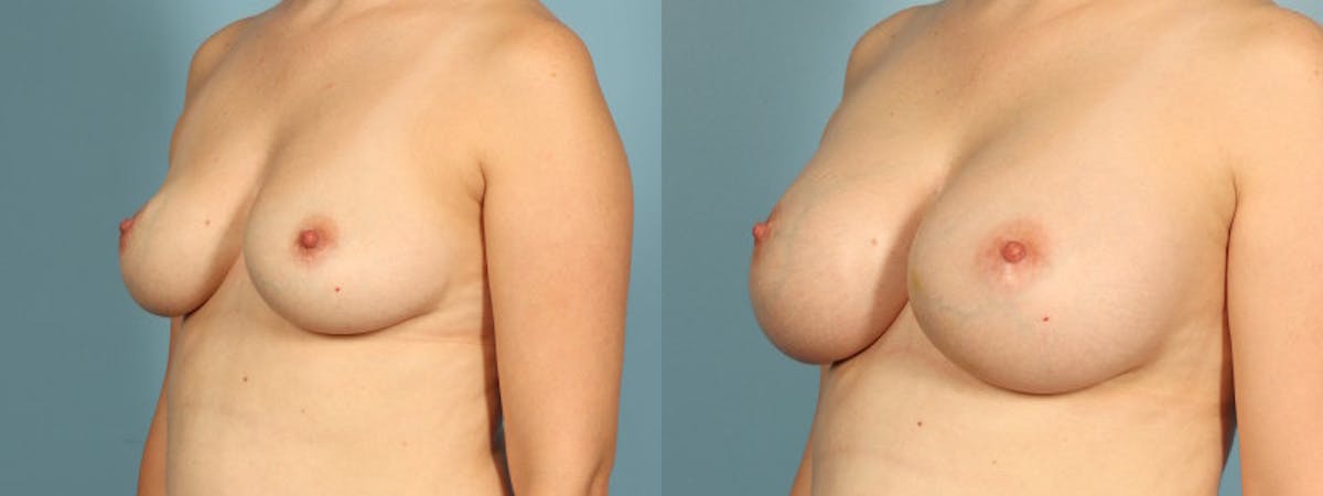 Breast Augmentation Before & After Gallery - Patient 361255 - Image 2