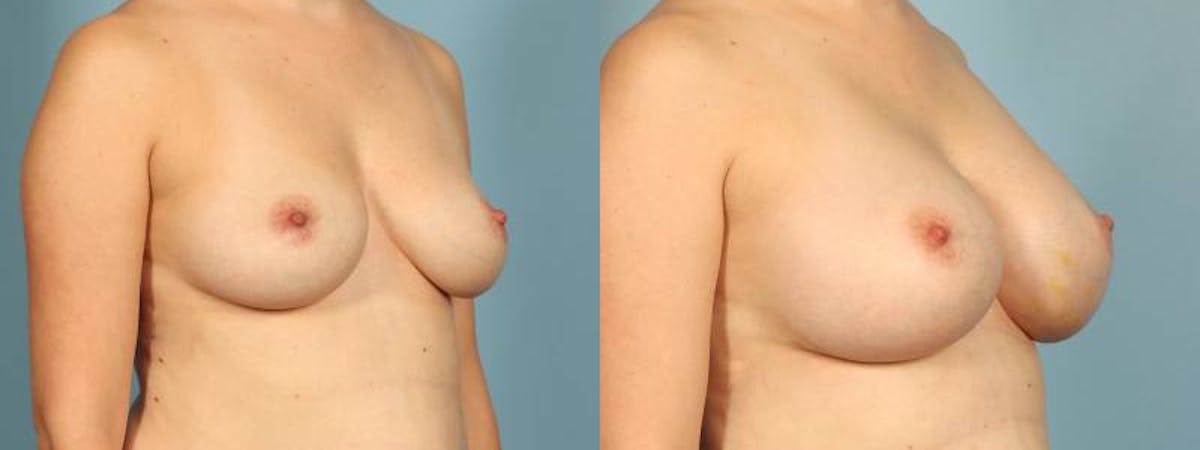 Breast Augmentation Before & After Gallery - Patient 361255 - Image 3