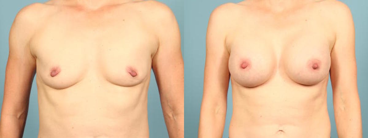Breast Augmentation Before & After Gallery - Patient 163422 - Image 1