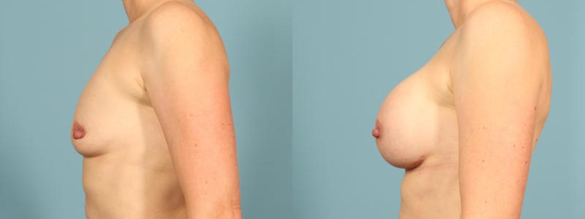 Breast Augmentation Before & After Gallery - Patient 163422 - Image 4