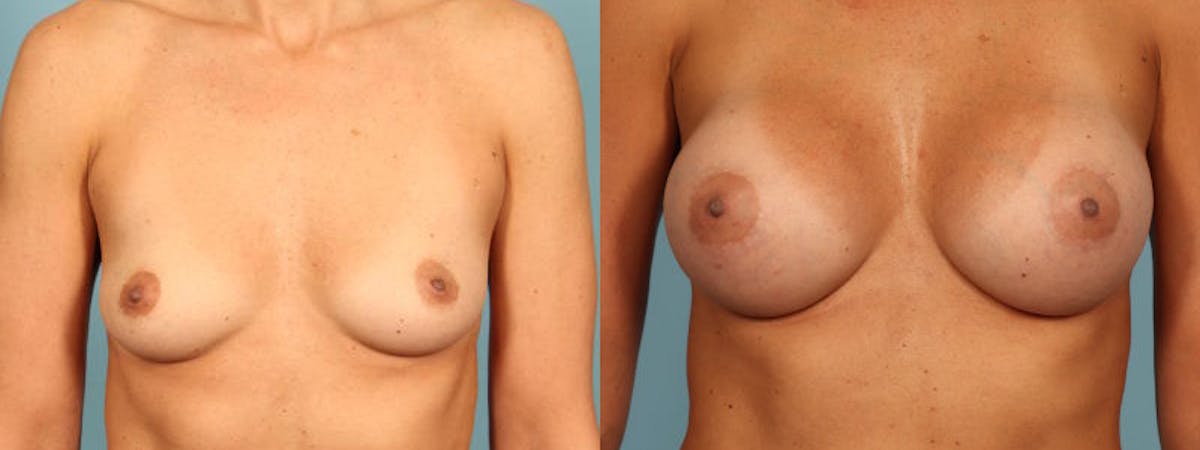 Breast Augmentation Before & After Gallery - Patient 257074 - Image 1