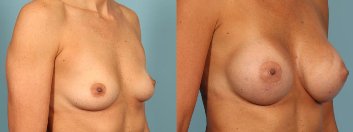 Breast Augmentation Before & After Gallery - Patient 257074 - Image 3