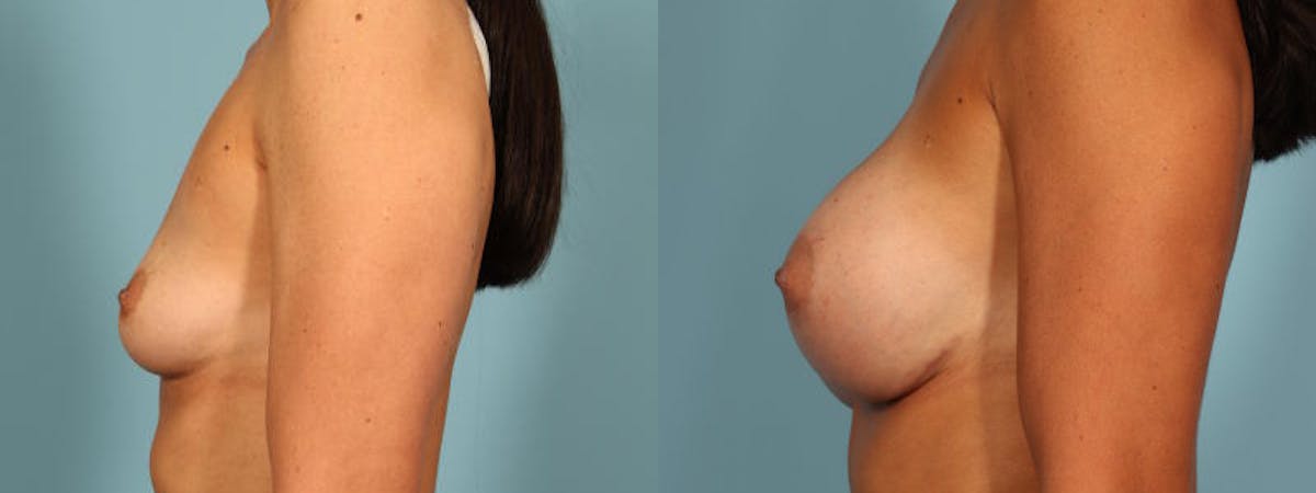 Breast Augmentation Before & After Gallery - Patient 257074 - Image 4