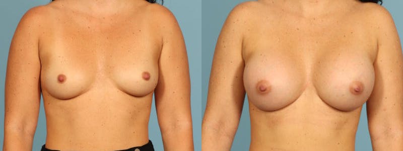 Breast Augmentation Before & After Gallery - Patient 137183 - Image 1