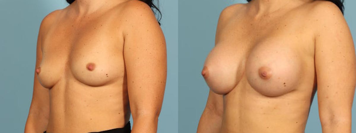 Breast Augmentation Before & After Gallery - Patient 137183 - Image 2