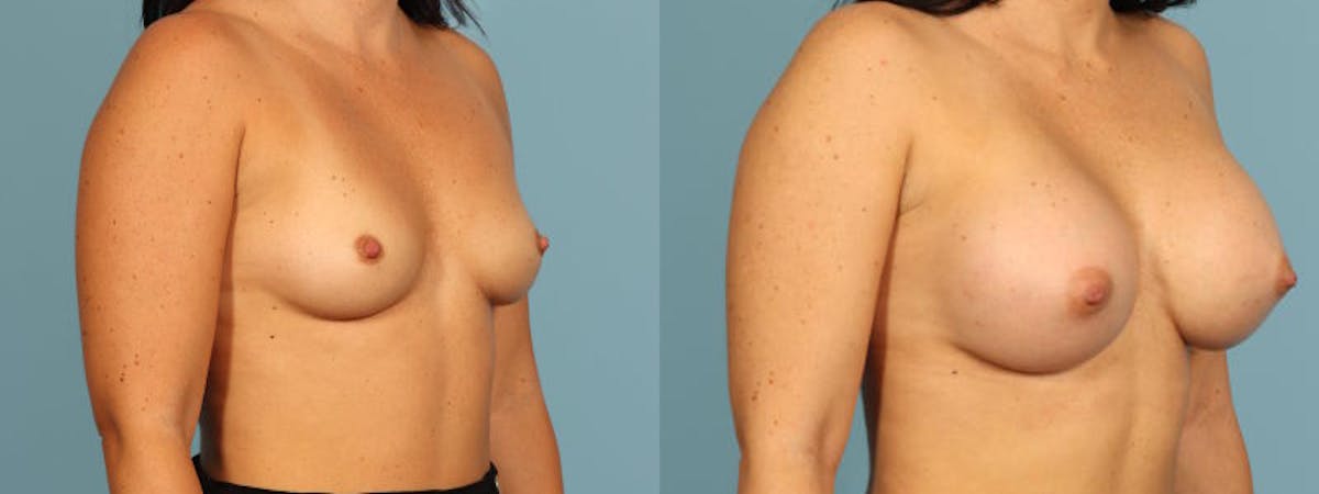 Breast Augmentation Before & After Gallery - Patient 137183 - Image 3