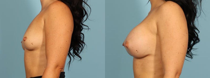Breast Augmentation Before & After Gallery - Patient 137183 - Image 4