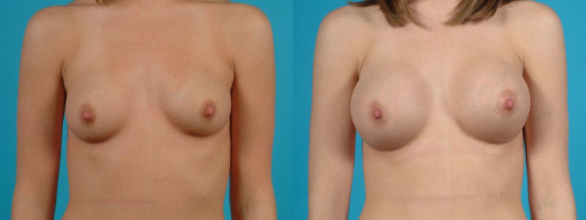 Breast Augmentation Before & After Gallery - Patient 187523 - Image 2