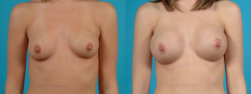 Breast Augmentation Before & After Gallery - Patient 187523 - Image 2