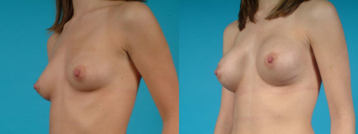 Breast Augmentation Before & After Gallery - Patient 187523 - Image 3