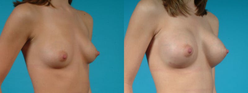 Breast Augmentation Before & After Gallery - Patient 187523 - Image 4