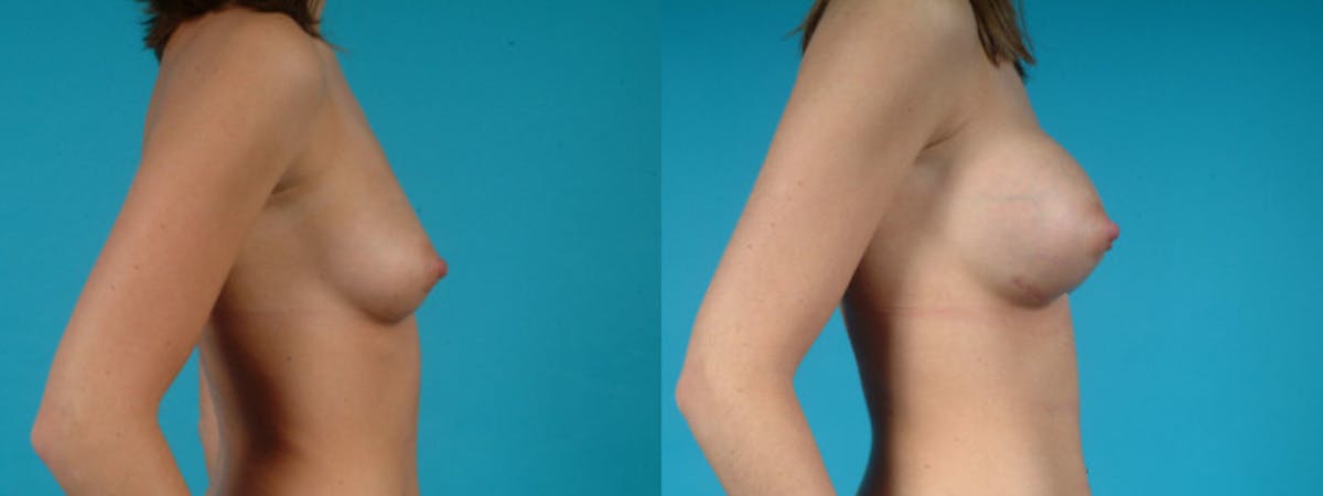 Breast Augmentation Before & After Gallery - Patient 187523 - Image 6