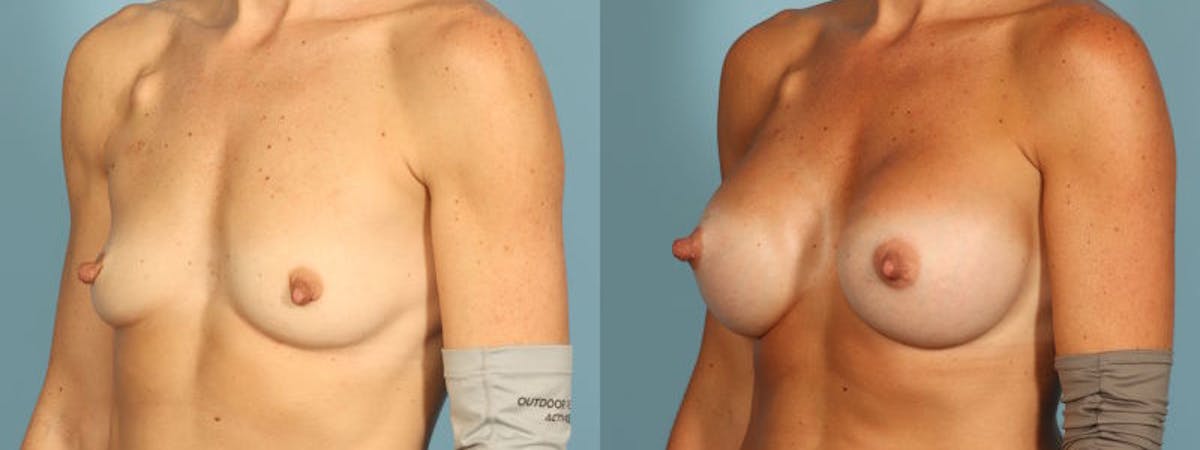 Breast Augmentation Before & After Gallery - Patient 155036 - Image 2