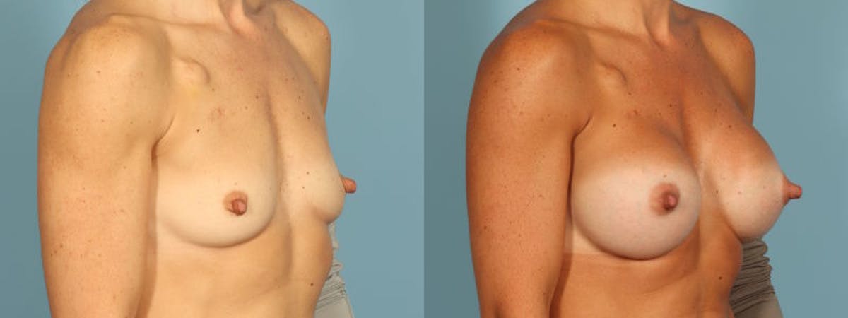 Breast Augmentation Before & After Gallery - Patient 155036 - Image 3