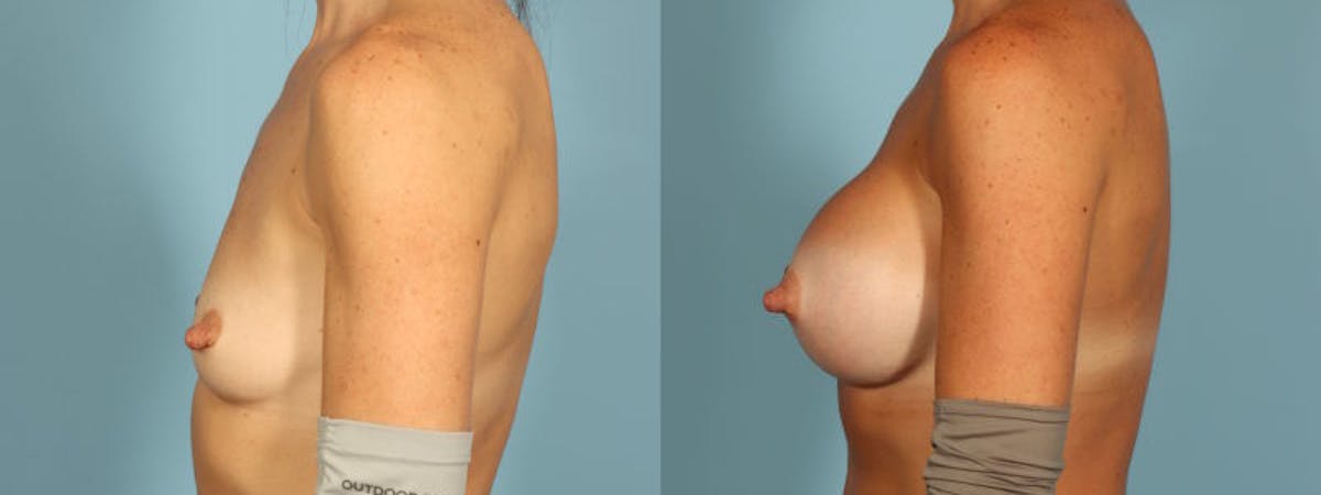 Breast Augmentation Before & After Gallery - Patient 155036 - Image 4