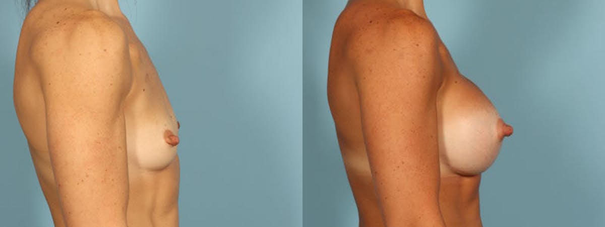 Breast Augmentation Before & After Gallery - Patient 155036 - Image 5