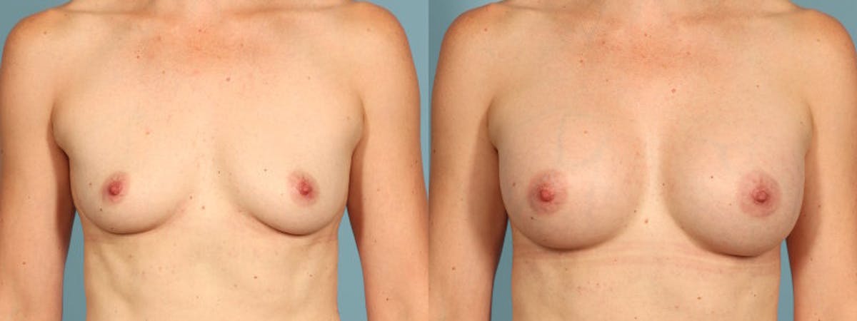 Breast Augmentation Before & After Gallery - Patient 230538 - Image 1