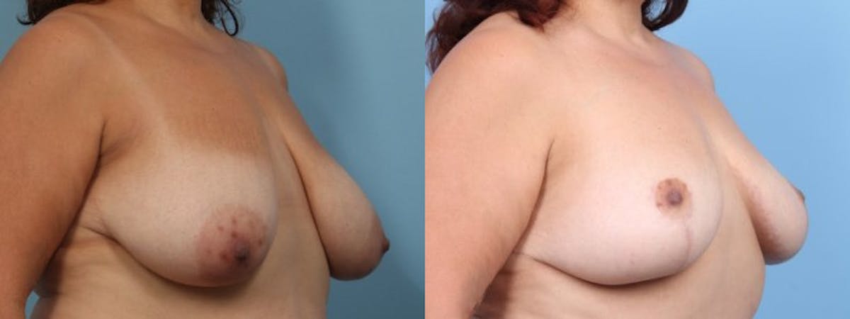 Breast Lift w/ Fat Grafting Before & After Gallery - Patient 373002 - Image 2