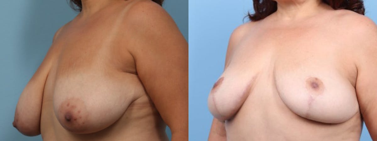 Breast Lift w/ Fat Grafting Before & After Gallery - Patient 373002 - Image 3