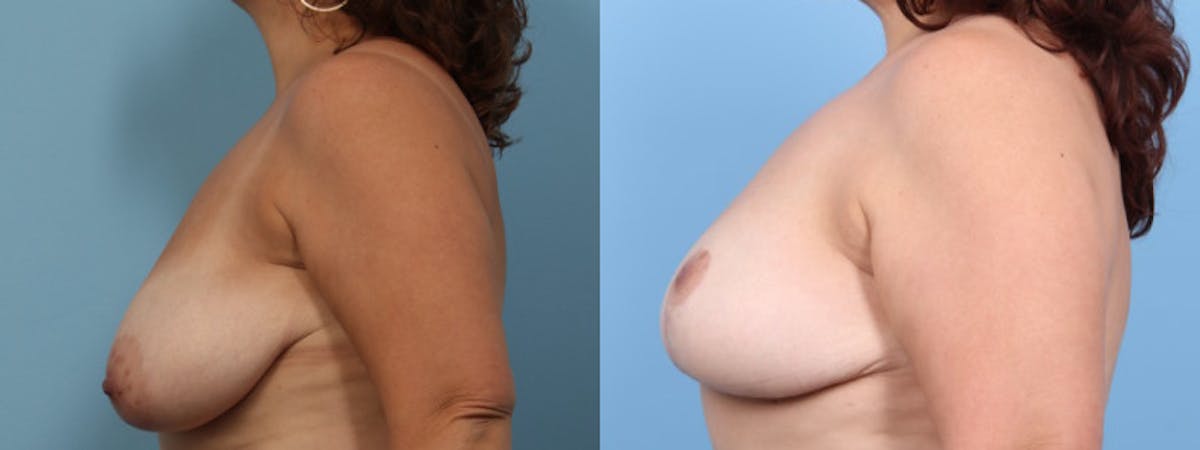 Breast Lift w/ Fat Grafting Before & After Gallery - Patient 373002 - Image 4
