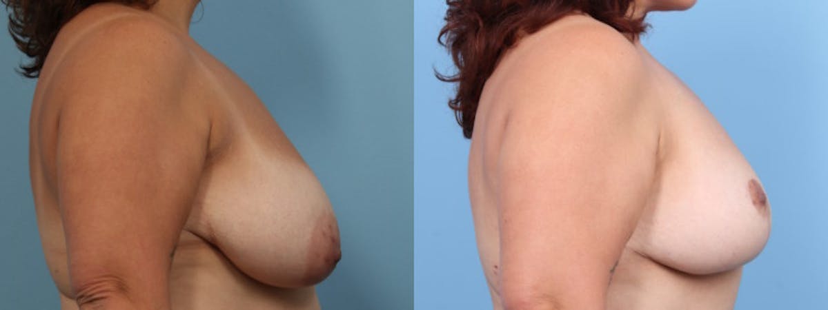 Breast Lift w/ Fat Grafting Before & After Gallery - Patient 373002 - Image 5
