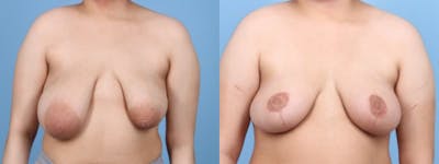 Breast Lift w/ Fat Grafting Before & After Gallery - Patient 353964 - Image 1