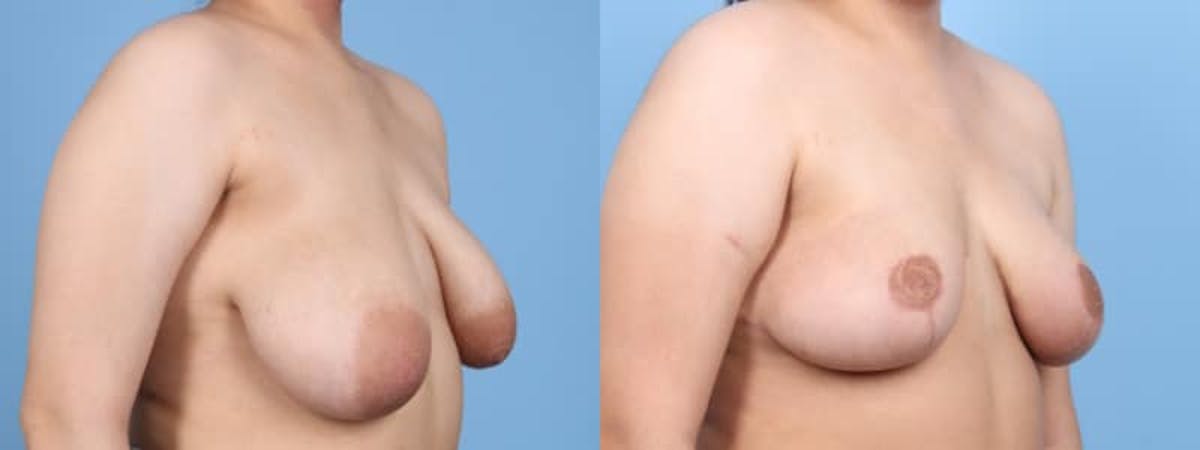 Breast Lift w/ Fat Grafting Before & After Gallery - Patient 353964 - Image 3