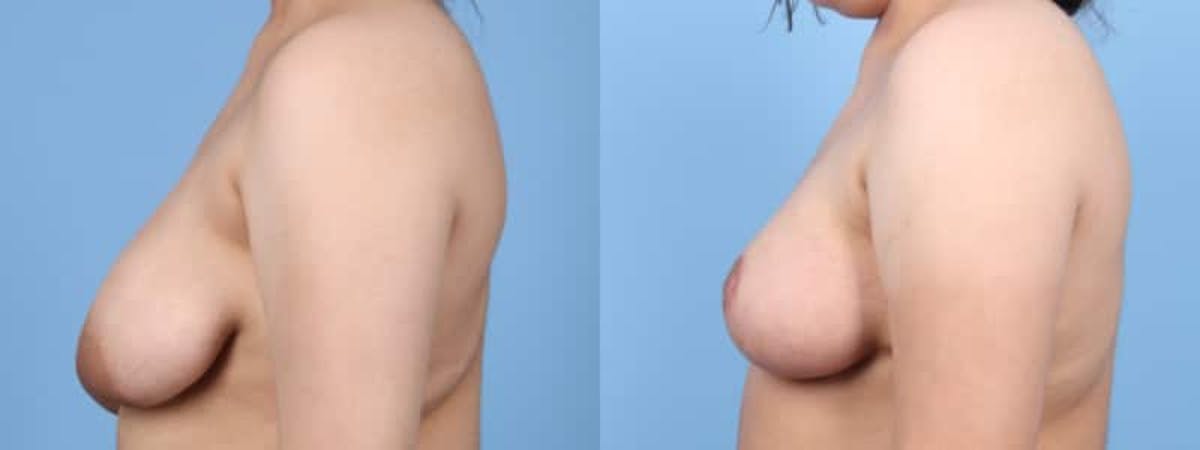 Breast Lift w/ Fat Grafting Before & After Gallery - Patient 353964 - Image 4
