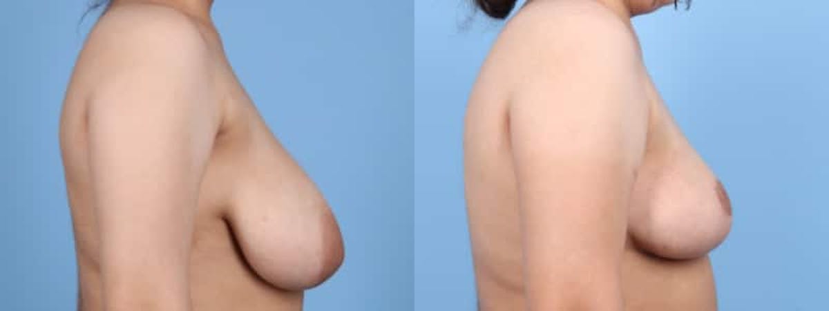 Breast Lift w/ Fat Grafting Before & After Gallery - Patient 353964 - Image 5