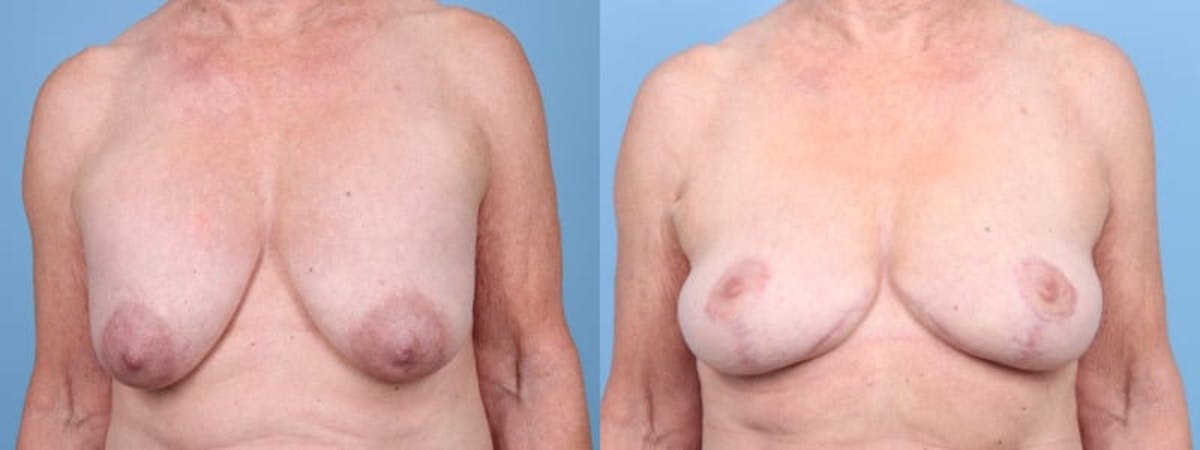 Breast Lift w/ Fat Grafting Before & After Gallery - Patient 303776 - Image 1