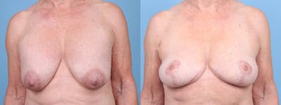 Breast Lift w/ Fat Grafting Before & After Gallery - Patient 303776 - Image 1