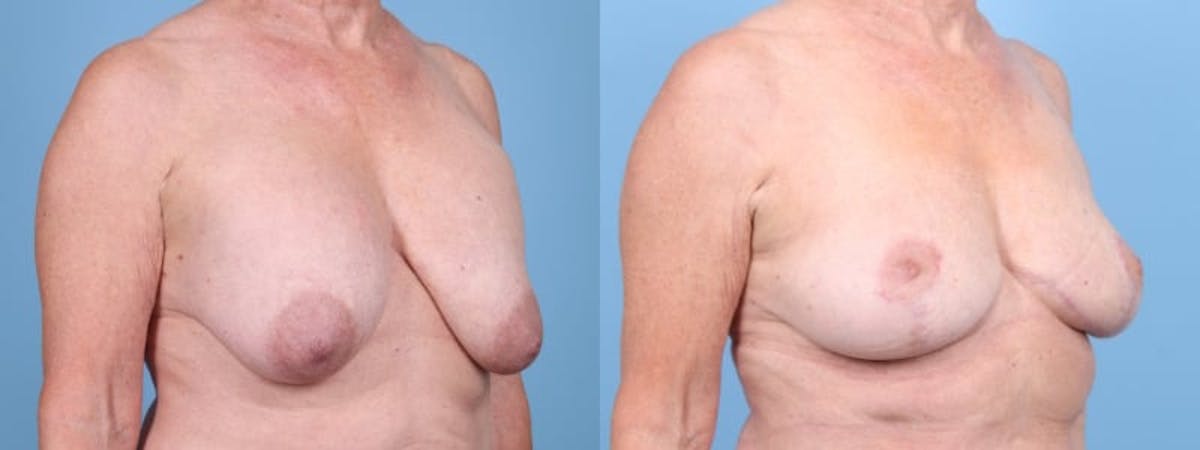 Breast Lift w/ Fat Grafting Before & After Gallery - Patient 303776 - Image 2