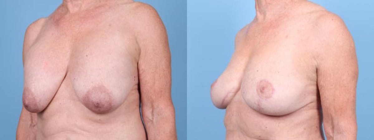 Breast Lift w/ Fat Grafting Before & After Gallery - Patient 303776 - Image 3
