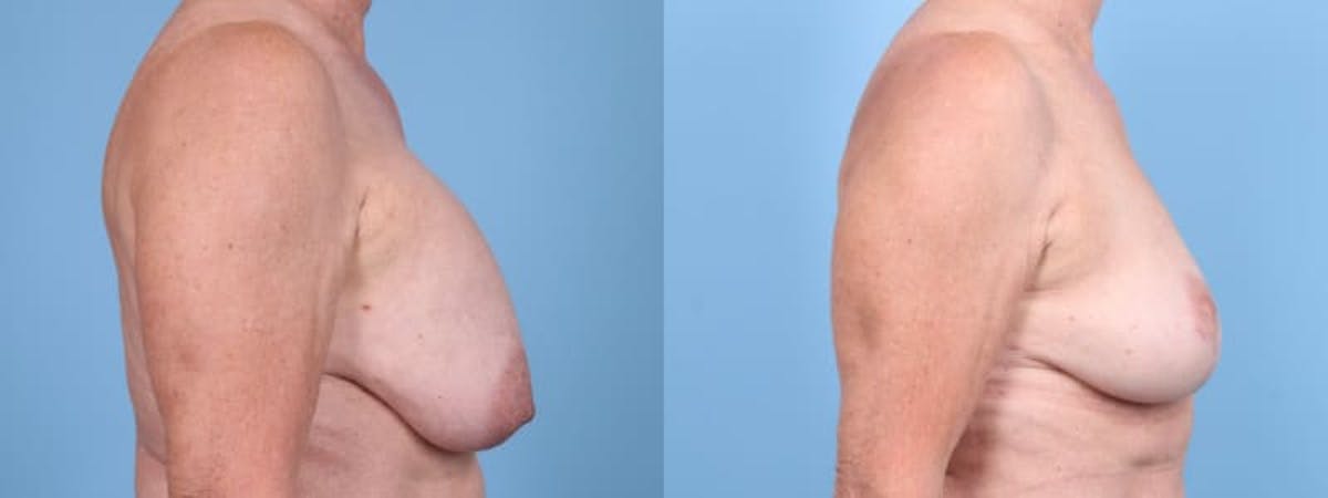 Breast Lift w/ Fat Grafting Before & After Gallery - Patient 303776 - Image 4