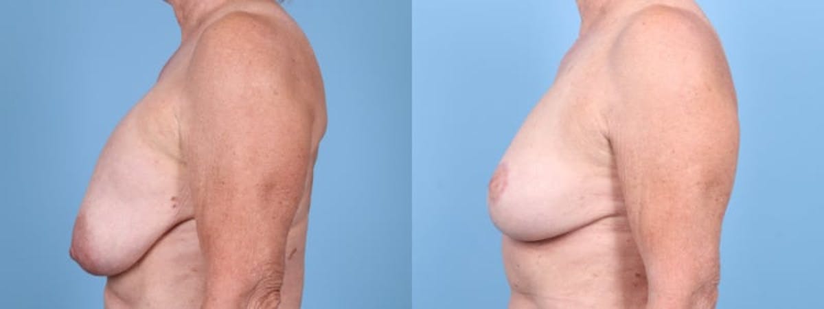 Breast Lift w/ Fat Grafting Before & After Gallery - Patient 303776 - Image 5