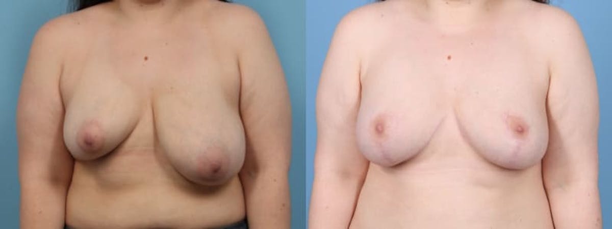 Breast Asymmetry Before & After Gallery - Patient 260320 - Image 1