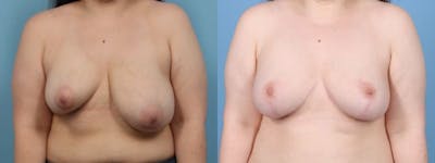 Breast Asymmetry Before & After Gallery - Patient 260320 - Image 1
