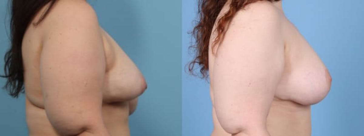 Breast Asymmetry Before & After Gallery - Patient 260320 - Image 4