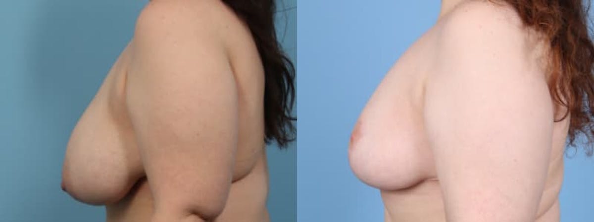 Breast Asymmetry Before & After Gallery - Patient 260320 - Image 5