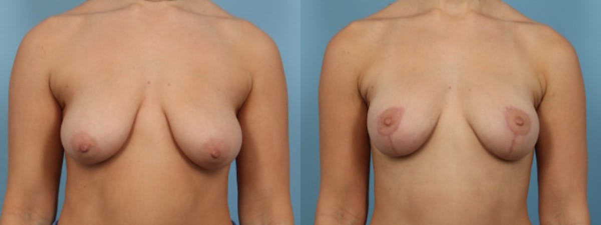 Breast Lift w/ Fat Grafting Before & After Gallery - Patient 297969 - Image 1