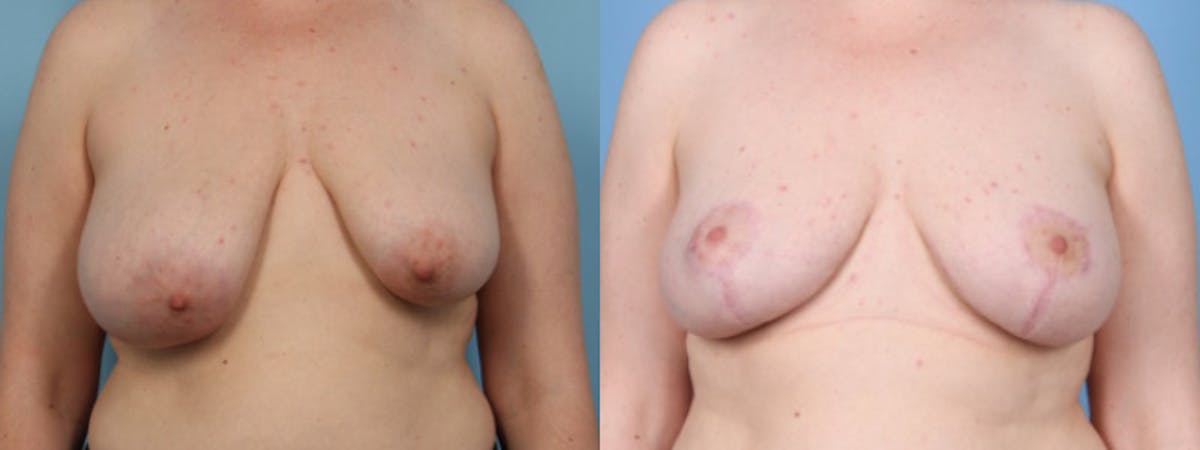 Breast Asymmetry Before & After Gallery - Patient 177693 - Image 1