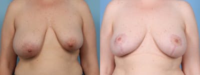Breast Asymmetry Before & After Gallery - Patient 177693 - Image 1
