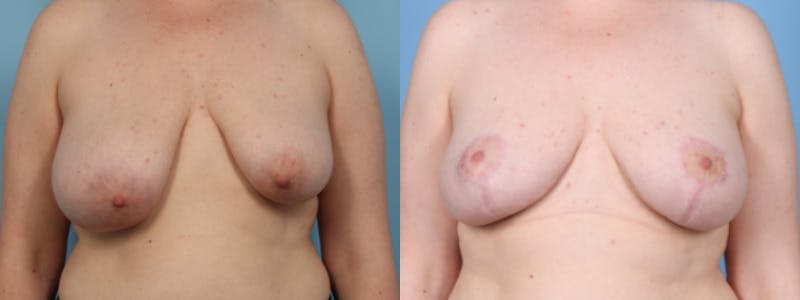 Breast Asymmetry Before & After Gallery - Patient 177693 - Image 1