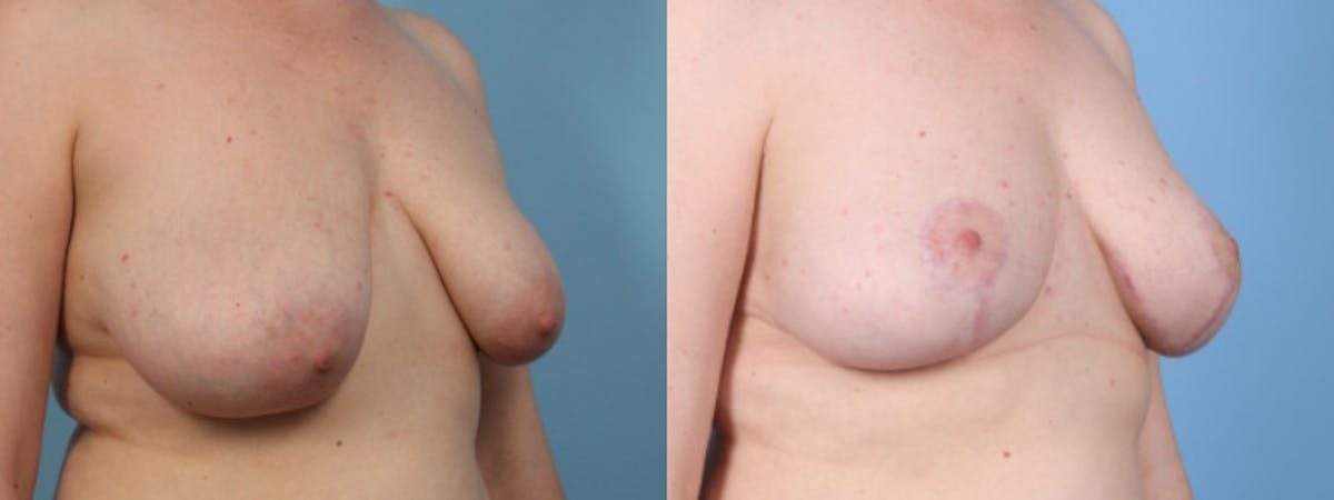 Breast Asymmetry Before & After Gallery - Patient 177693 - Image 2