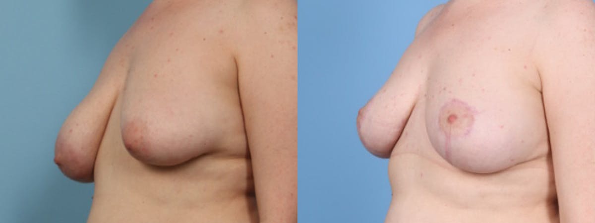 Breast Asymmetry Before & After Gallery - Patient 177693 - Image 3