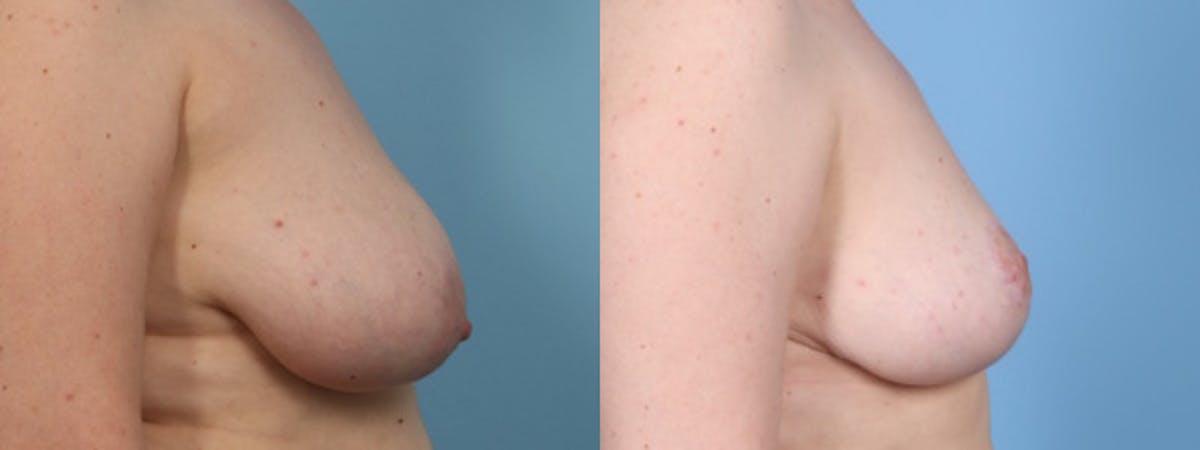 Breast Asymmetry Before & After Gallery - Patient 177693 - Image 4