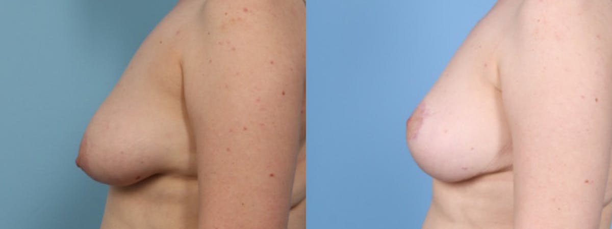 Breast Asymmetry Before & After Gallery - Patient 177693 - Image 5