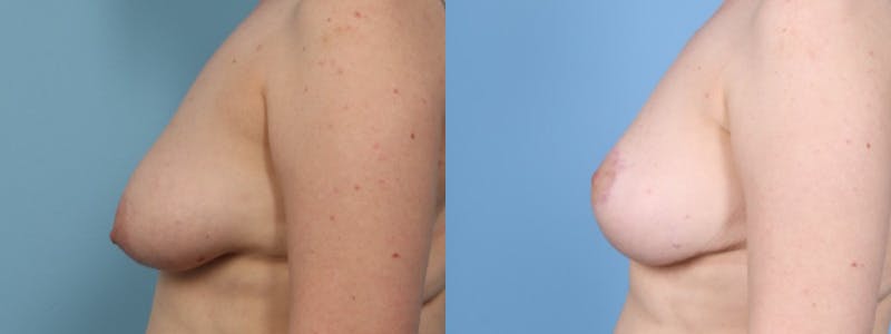 Breast Asymmetry Before & After Gallery - Patient 177693 - Image 5