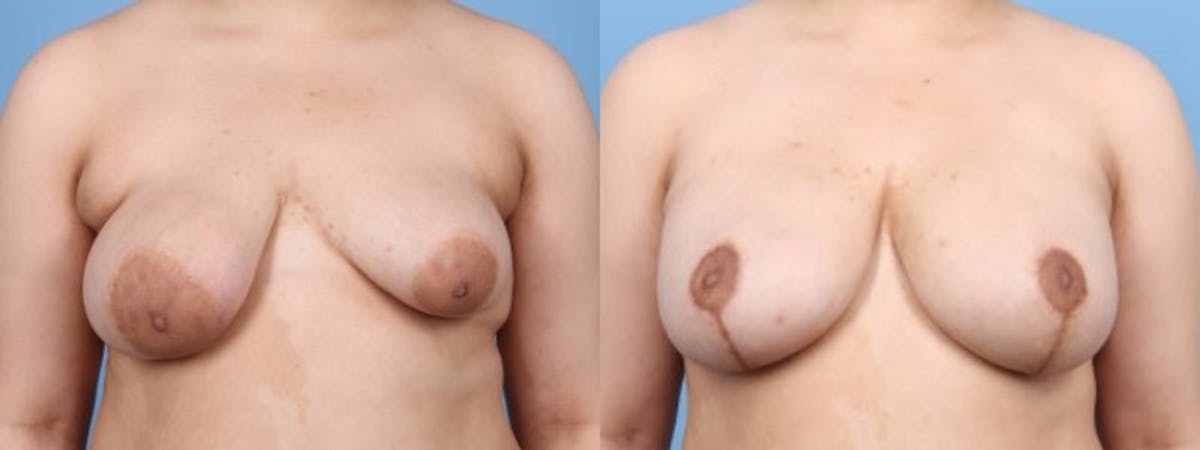 Breast Asymmetry Before & After Gallery - Patient 124069 - Image 1